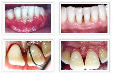  Die Parodontose ist eine entzündliche Erkrankung des Zahnhalteapparates, die unbehandelt zunächst zu Zahnlockerung und letztendlich zu Zahnverlust führen kann.