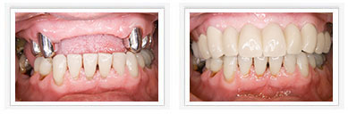 Wenn mehrere Zähne ersetzt werden müssen, bieten wir Ihnen mit der Dortmunder Doppelkrone eine besonders wirtschaftliche Lösung.